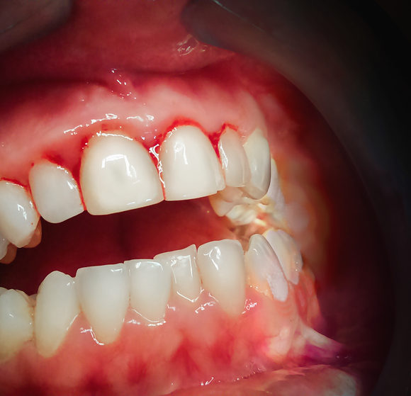 7 things to know about periodontal/gum care