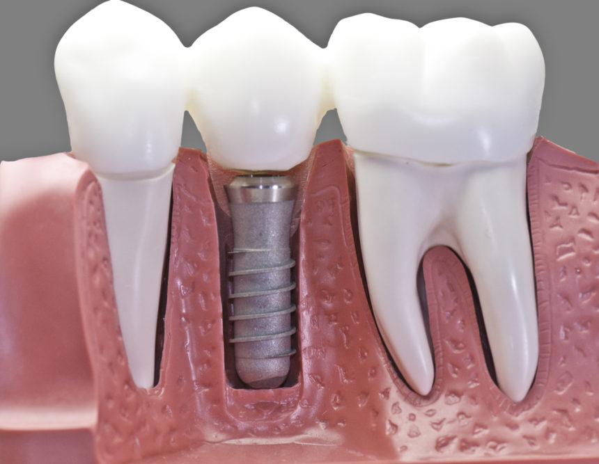 Everything you need to know about dental implants