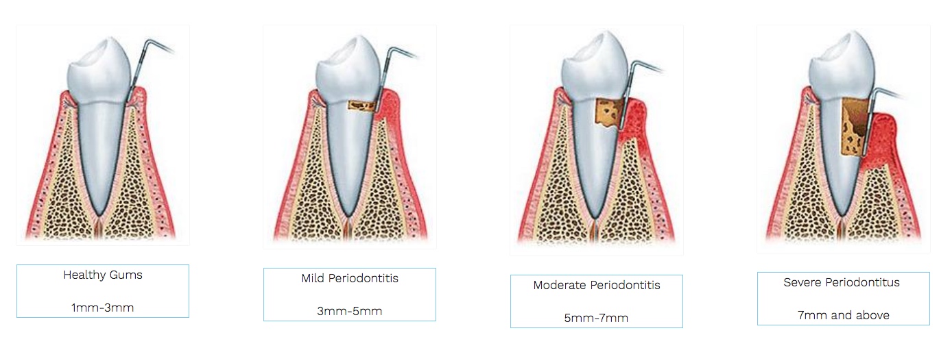 7 things to know about periodontal/gum care | Dandenong Dentists