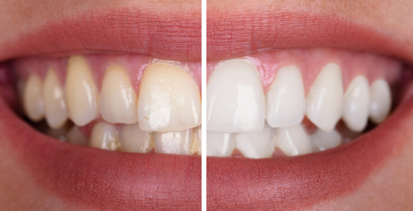 What are the different types of whitening techniques?