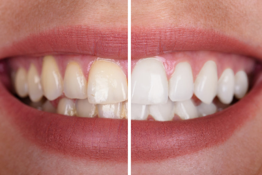 What are the different types of whitening techniques?